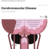 CONTINUUM Lifelong Learning in Neurology April 2023 Volume 29 Issue 2 True PDF