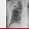 Harvard Infectious Diseases in Adults 2024