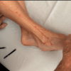 Lyftogt Perineural Injection Treatment videos: Mastering the Lower Leg Online