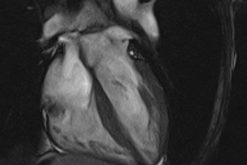 MRIOnline Mastery Series Cardiac MRI of Non Ischemic Cardiomyopathy 2021 CME VIDEOS