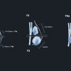MRIOnline Mastery Series Evaluation of Newly Diagnosed Pre Operative Breast Cancer Patients 2021 CME VIDEOS