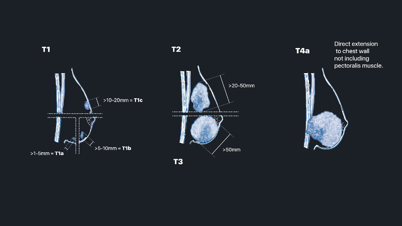 MRIOnline Mastery Series Evaluation of Newly Diagnosed Pre Operative Breast Cancer Patients 2021 CME VIDEOS