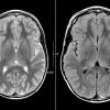 MRIOnline Mastery Series Neurofibromatosis Type 1 NF1 2021