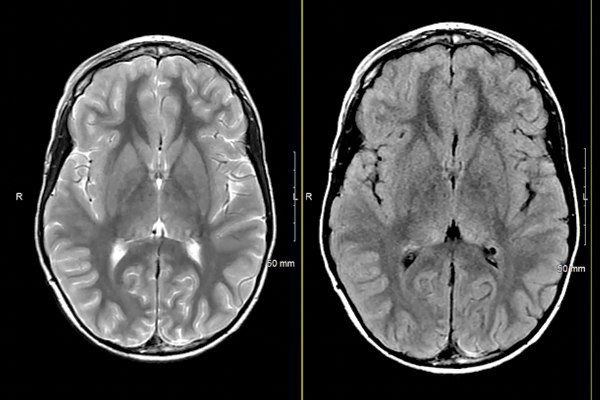 MRIOnline Mastery Series Neurofibromatosis Type 1 NF1 2021