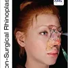 Non Surgical Rhinoplasty The PRIME Series EPUB