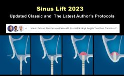 OHI S Sinus Lift 2023 Updated Classic and the Latest Authors Protocols
