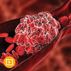 Thrombosis Thromboembolism 2022 CME VIDEOS