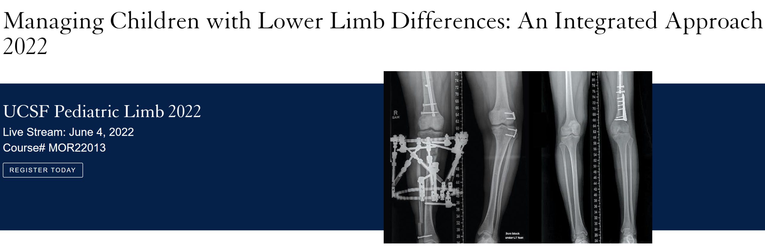 UCSF Managing Children with Lower Limb Differences An Integrated Approach 2022