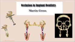 occlusion in implant dentistry 510x288 2
