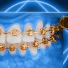 OHI-S Impaction Treatment Author’s Protocols, Mistakes and Solutions