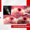 pikos-institute-immediate-dentoalveolar-restoration