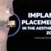 OHI-S Implant placement in the aesthetic zone steps and techniques