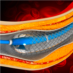 Comprehensive Review and Update of What’s New in Vascular and Endovascular Surgery