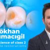 OHI-S Art and science of class 2 composite restorations