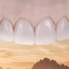 OHI-S Fixed Prosthetic Restorations common mistakes and advanced solutions