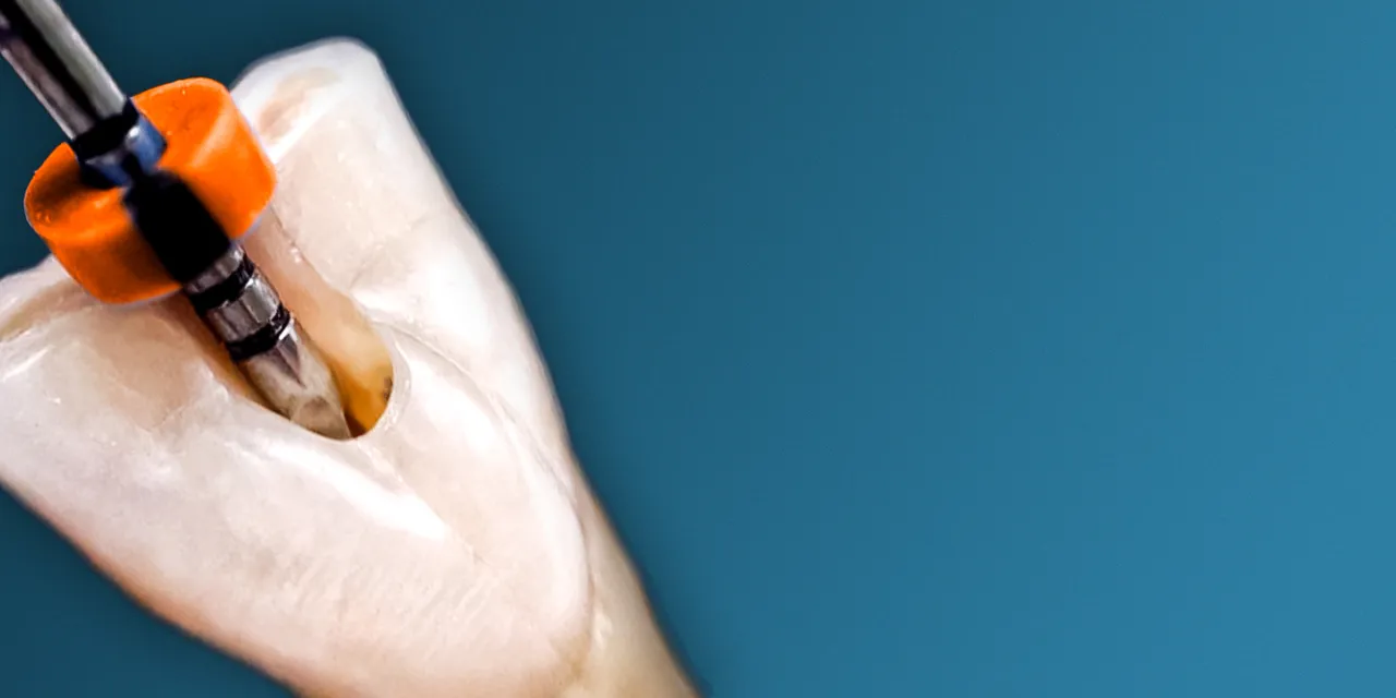 OHI-S Root perforations – diagnosis and treatment