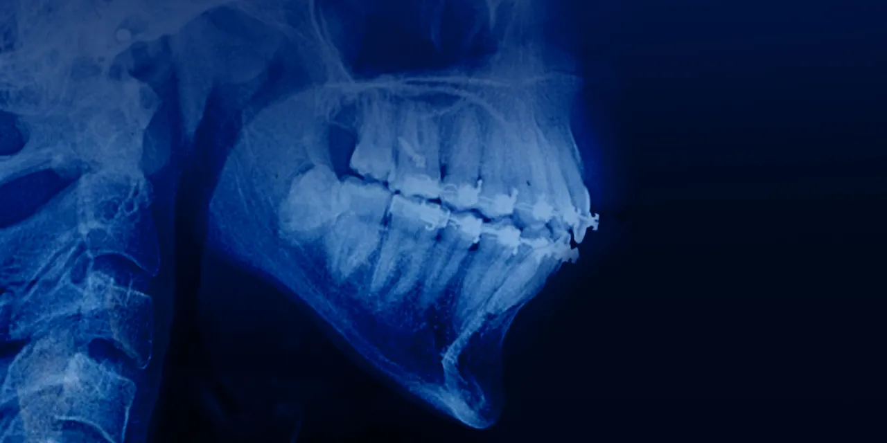 OHI-S Orthodontic treatment in patients with periodontal and alveolar bone pathology