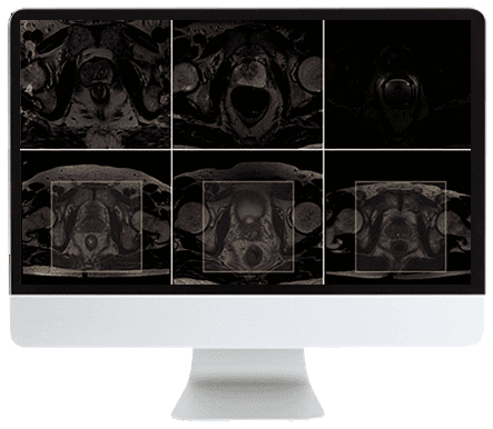 ARRS Pearls and Pitfalls in Prostate and Pelvic Imaging 2021