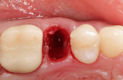Gidedental Extraction Socket – Preservation/Grafting; Immediate vs Delayed Implants; Pontic Site Development 2020
