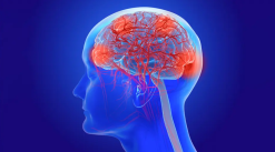 University of Miami Thinking Through Alzheimer’s